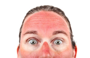 Sunburns Continue To Cause Damage Hours After Exposure